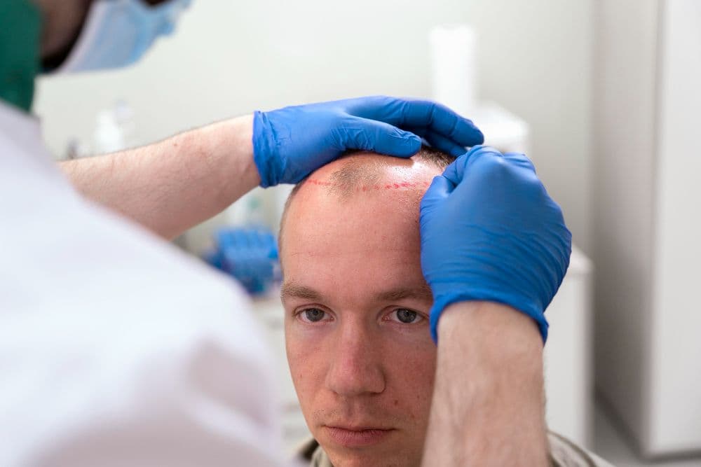 MosHair Clinic Kocaeli saç ekimi operasyonu sırasında uzman doktorun işlem yaptığı hasta yakın plan görseli