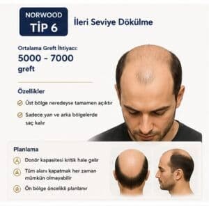 Norwood tipi saç ekimi tip6